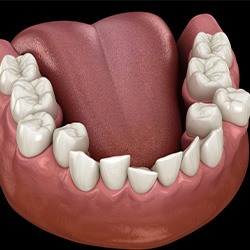 Illustration of crowded teeth