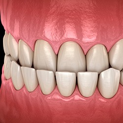 Illustration of an underbite