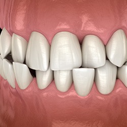 Illustration of a crossbite