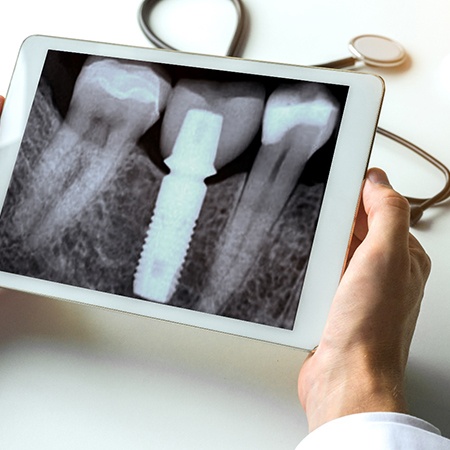 Implant dentist in Savannah looking at an X-ray of dental implant