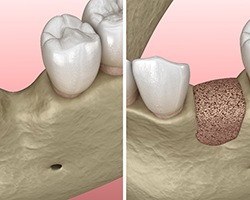 before and after diagram of a bone graft in Savannah for dental implants