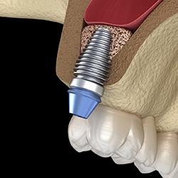 Diagram of after a sinus lift in Savannah for dental implants