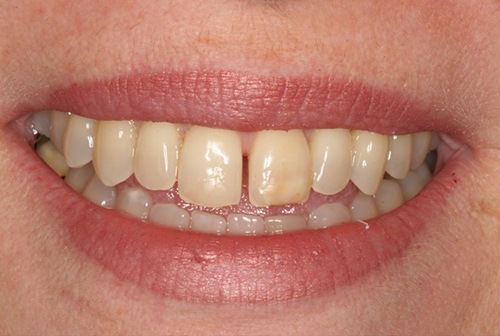 Gap between front two teeth