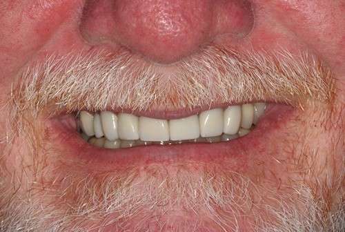 Flawlessly repaired front teeth