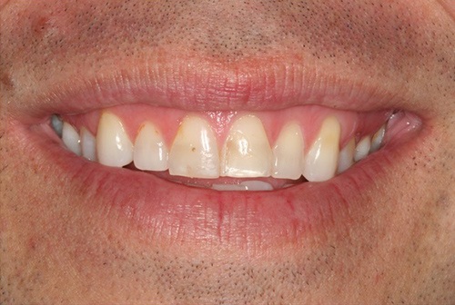 Irregularly sized top front teeth