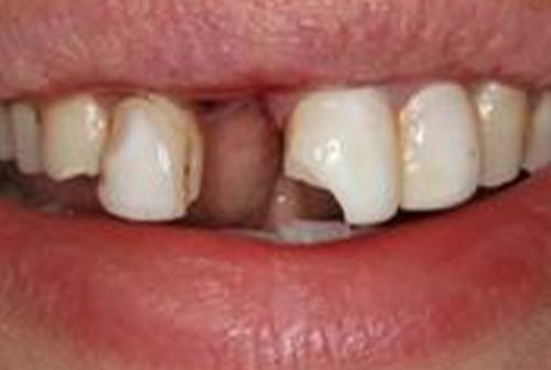 Irregularly sized top front teeth