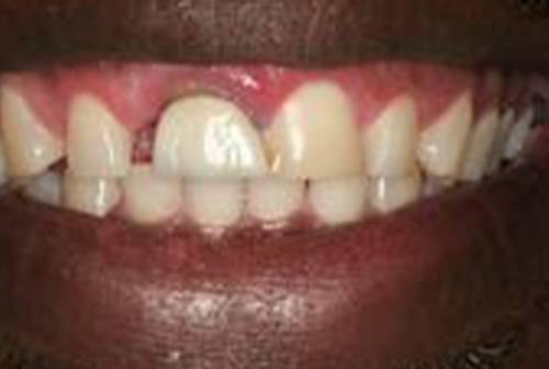 Irregularly sized top front teeth