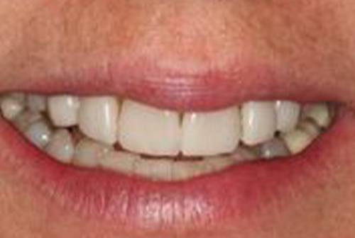 Irregularly sized top front teeth