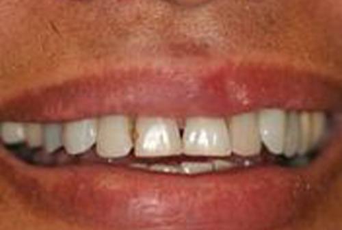 Irregularly sized top front teeth