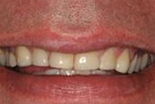 Irregularly sized top front teeth