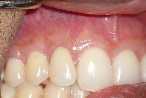 Closeup of healthy teeth and gums