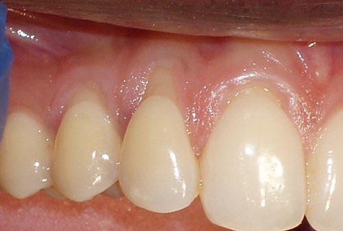 Closeup of smile with receding gums