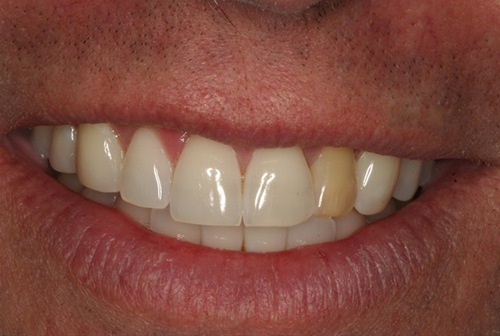 Dark colored top tooth