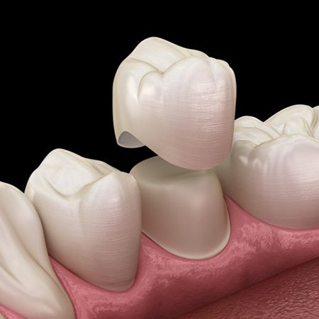 dental crown being fitted over a tooth 