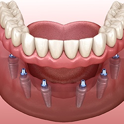 diagram of implant dentures