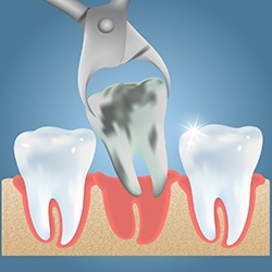 Forceps removing decayed tooth on blue background 