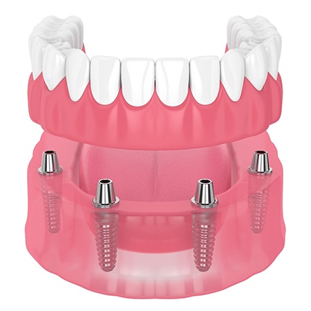 Illustration of dentures and dental implants for lower jaw