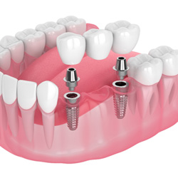 Illustration of an implant bridge