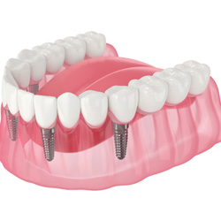 Illustration of an implant denture