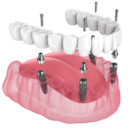 Illustration of all-on-4 dentures