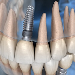 single dental implant in a patient’s upper arch