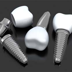 Diagram highlighting components of dental implants in Savannah