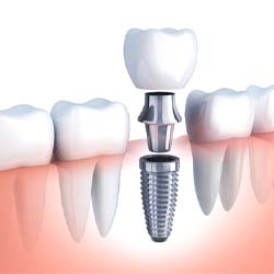 Diagram highlighting components of a dental implant in Savannah