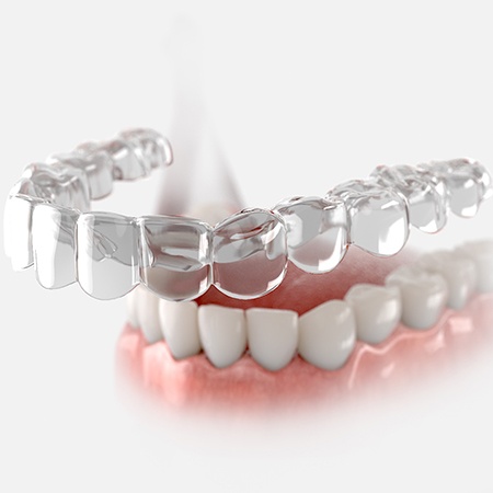 Illustration of clear aligner being placed on lower teeth