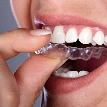 A person inserting a top MTM clear aligner to help straighten their smile