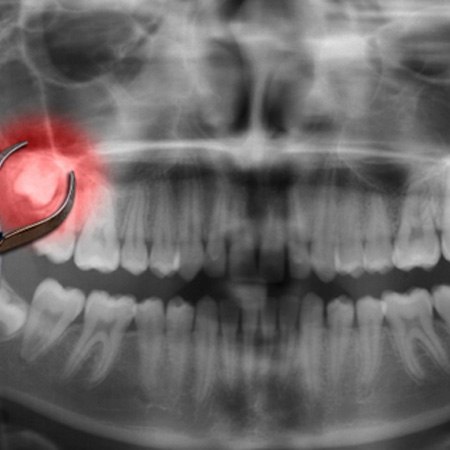 A dental x-ray of a wisdom tooth laying underneath a dentist’s tool 