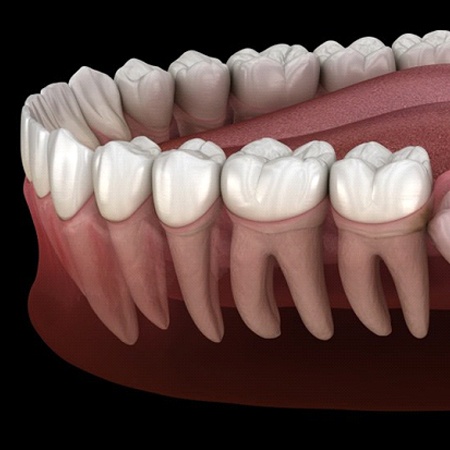 impacted wisdom tooth