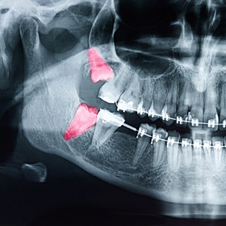 wisdom teeth on x-ray