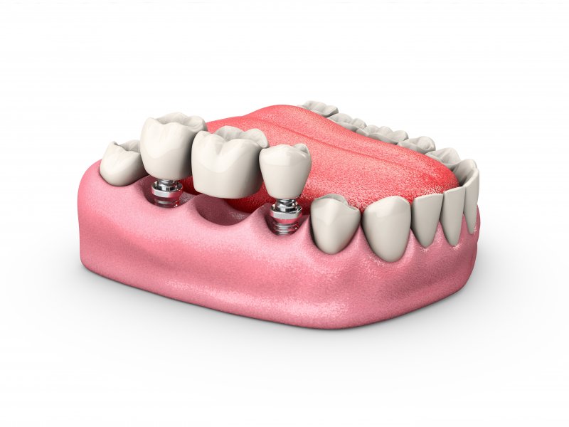 a dental implant bridge