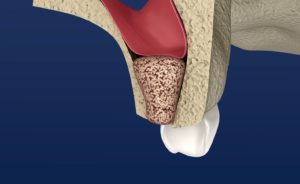 Image of bone graft procedure for dental implant