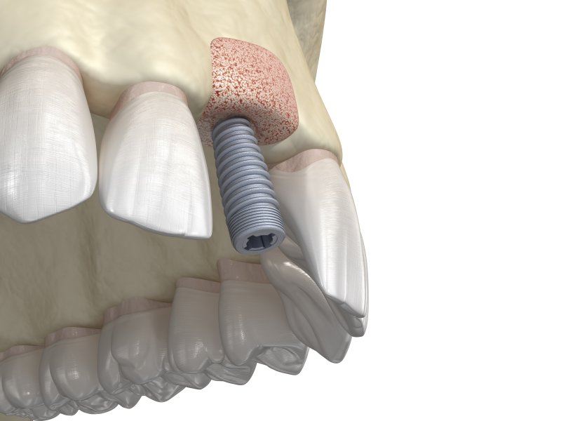 Bone graft