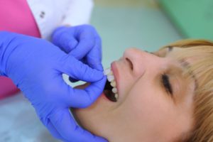 a woman getting veneers placed at the dentist