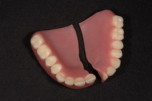 Picture of broken dentures