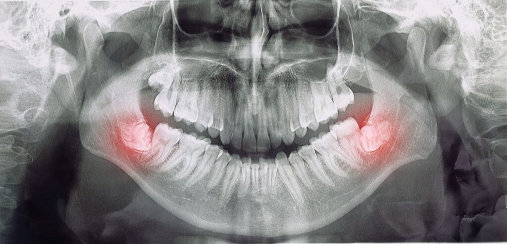 X-ray with red wisdom teeth in lower arch