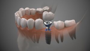 Rendering of dental implant. 
